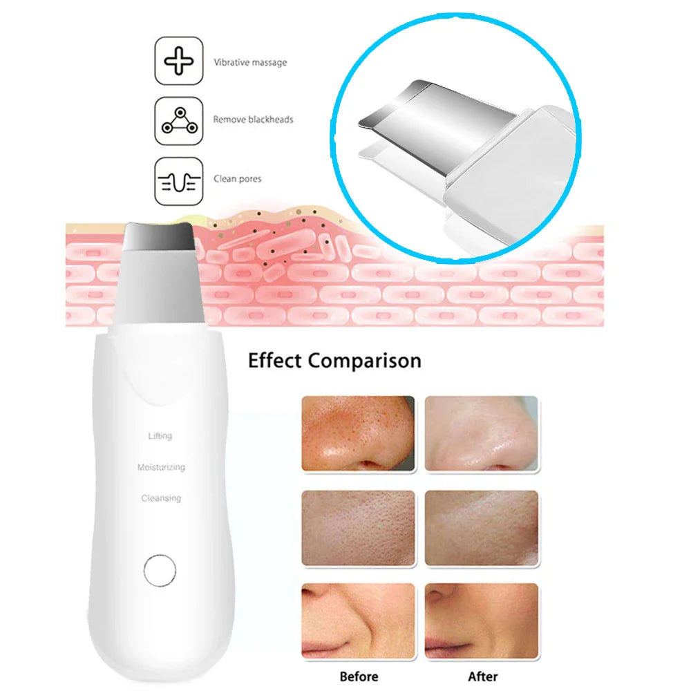 White ultrasonic facial skin scrubber with skin texture diagrams and before and after results