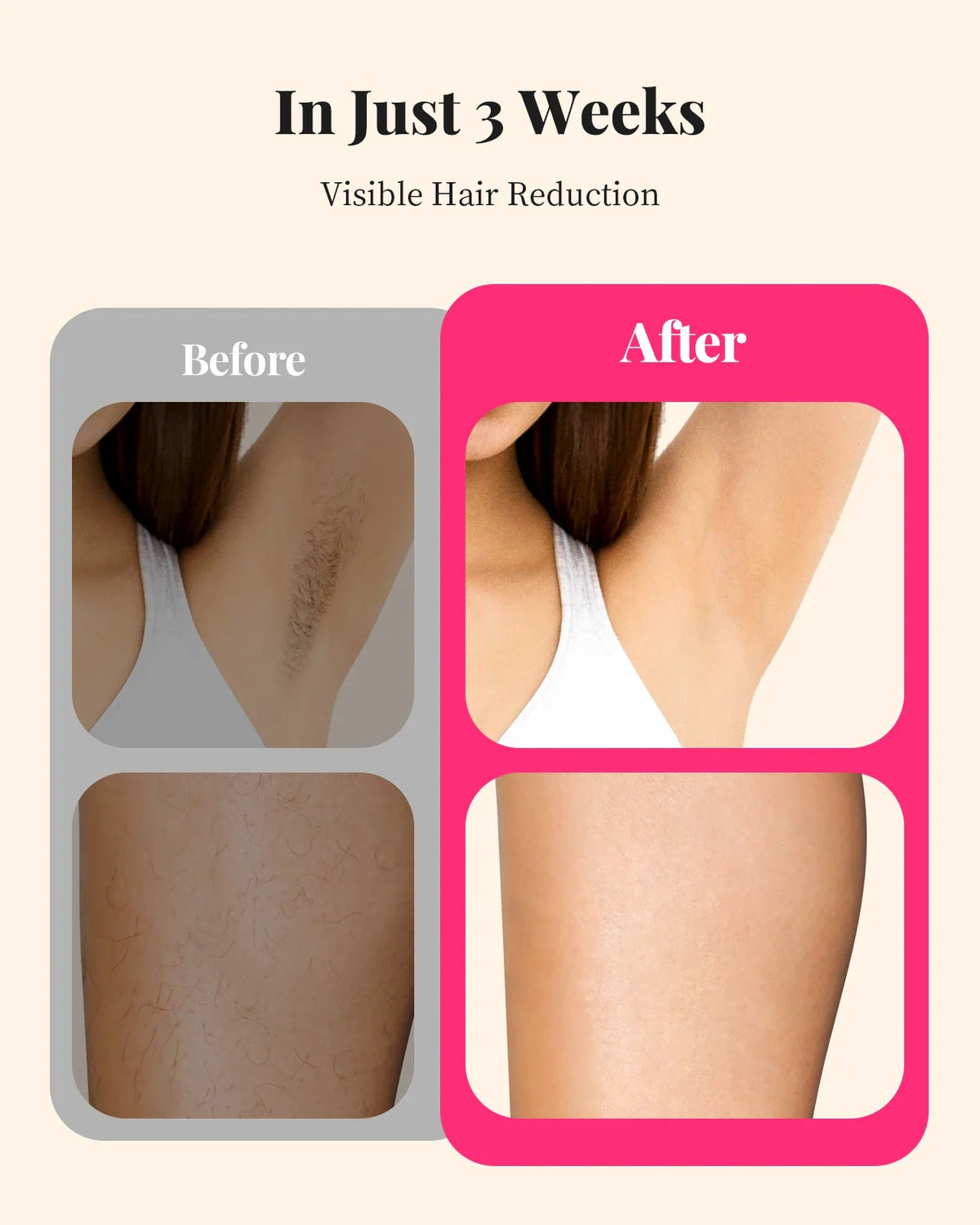 Before and after comparison of hair reduction results after three weeks of treatment